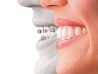 GoodSmiles Dental Care | Viora V30, Invisalign reg and Botox reg